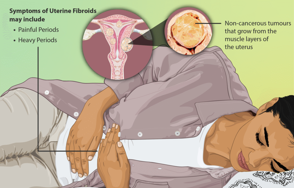 What Are Uterine Fibroids? A Simple Guide for Patients